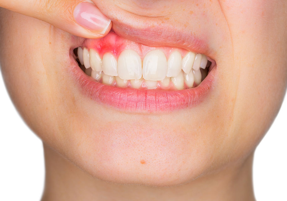 歯根や歯の周囲で増殖した細菌が、歯肉や顎骨に侵入して炎症を起こすことがあります。